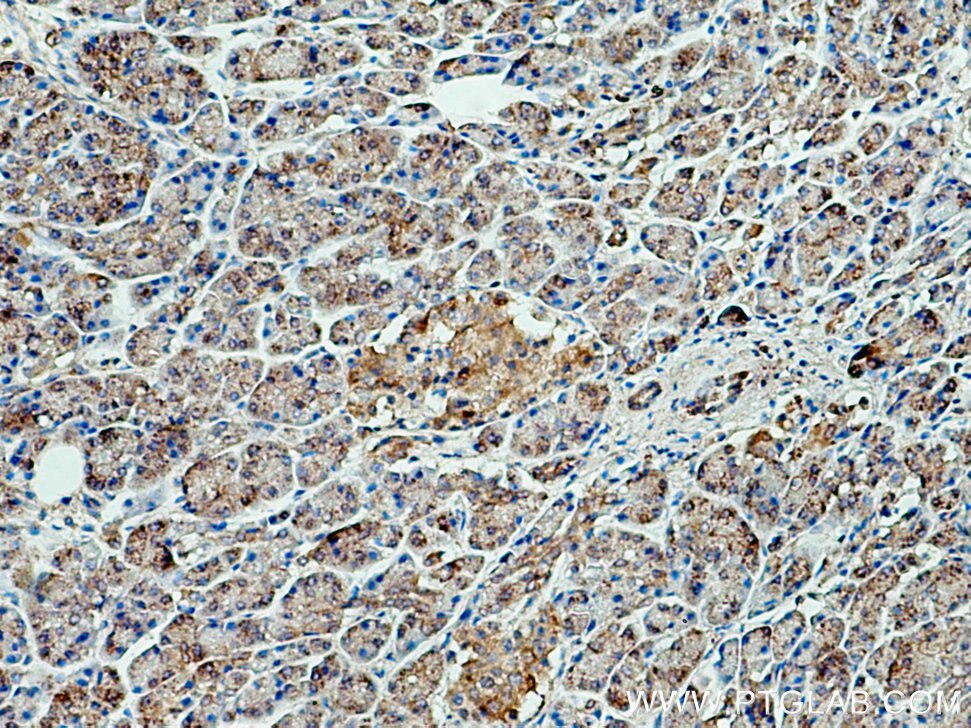 Immunohistochemistry (IHC) staining of human pancreas cancer tissue using GCAT Polyclonal antibody (16317-1-AP)