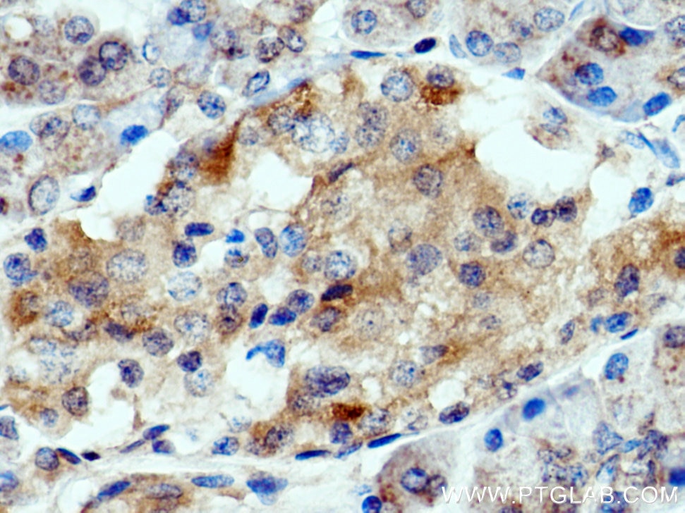 Immunohistochemistry (IHC) staining of human pancreas cancer tissue using GCAT Polyclonal antibody (16317-1-AP)