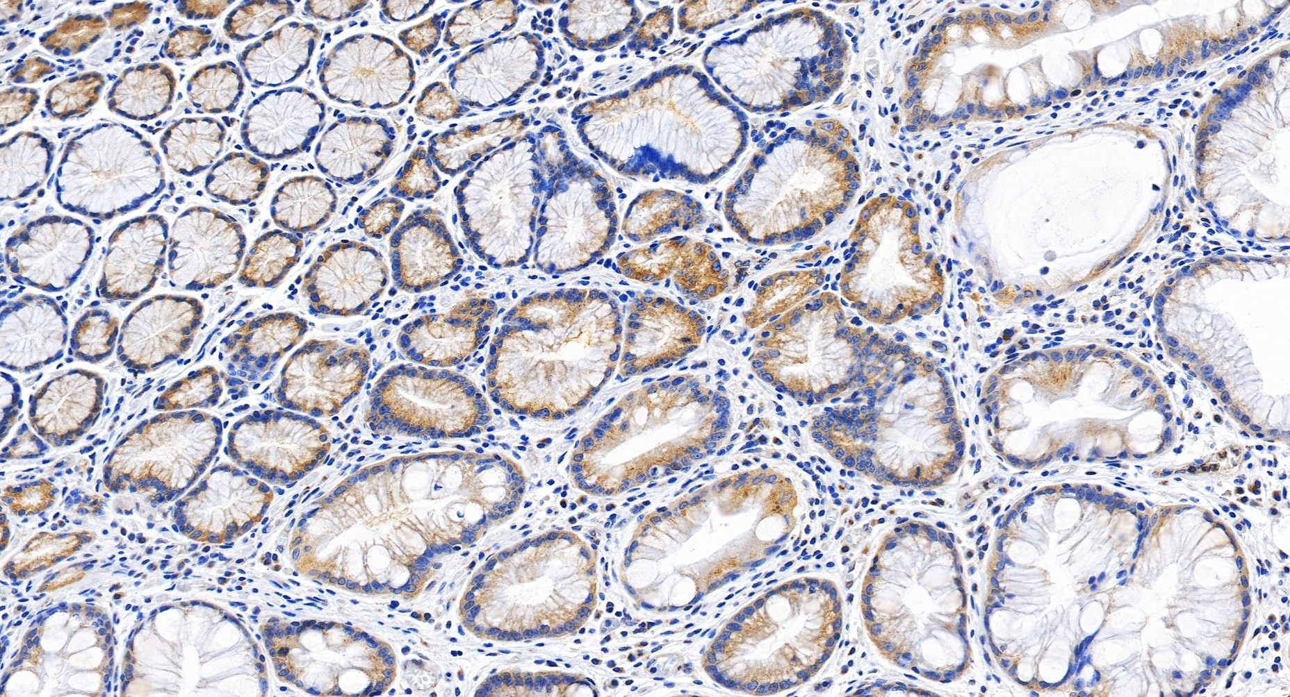 Immunohistochemical analysis of paraffin-embedded human stomach cancer tissue slide using 32217-1-AP (GCC2 antibody) at dilution of 1:4000 (under 20x lens). Heat mediated antigen retrieval with Tris-EDTA buffer (pH 9.0). Immunohistochemistry (IHC) staining of human stomach cancer tissue using GCC2 Polyclonal antibody (32217-1-AP)