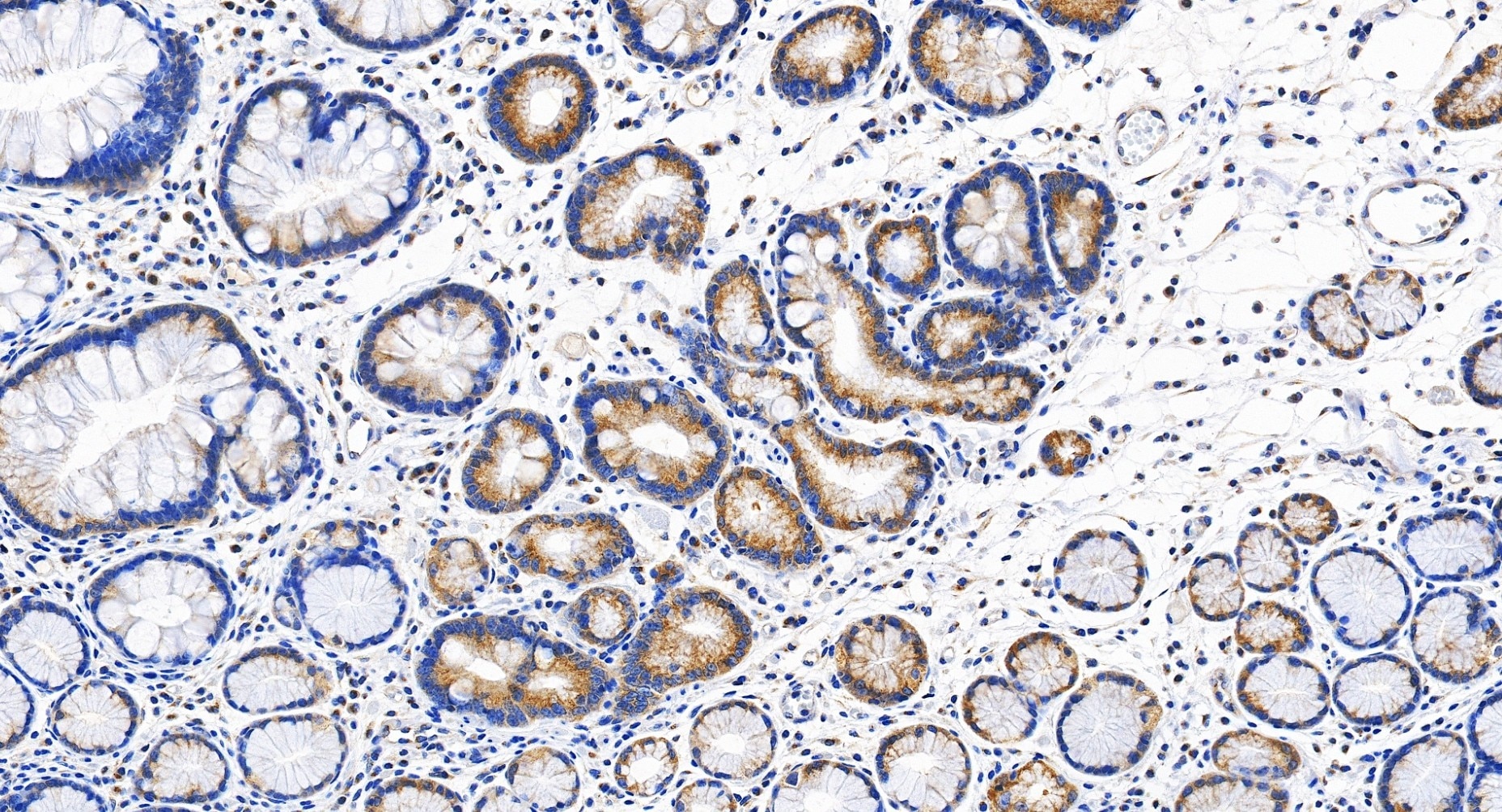 Immunohistochemical analysis of paraffin-embedded human stomach cancer tissue slide using 32217-1-AP (GCC2 antibody) at dilution of 1:4000 (under 20x lens). Heat mediated antigen retrieval with Tris-EDTA buffer (pH 9.0). Immunohistochemistry (IHC) staining of human stomach cancer tissue using GCC2 Polyclonal antibody (32217-1-AP)