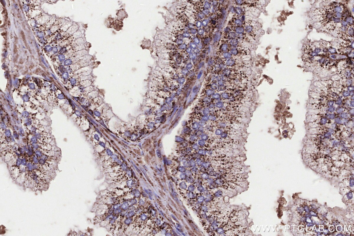 Immunohistochemistry (IHC) staining of human prostate cancer tissue using GCDH Polyclonal antibody (14930-1-AP)