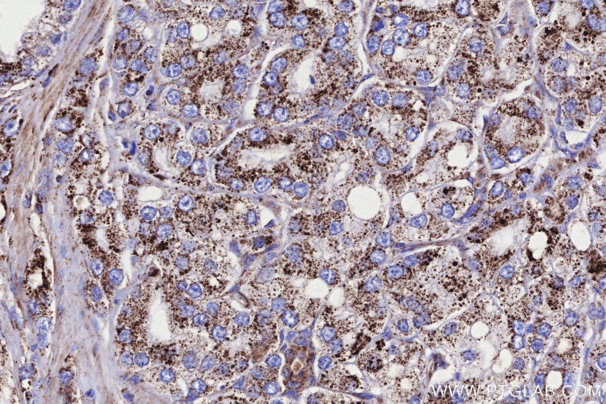 Immunohistochemistry (IHC) staining of human prostate cancer tissue using GCDH Polyclonal antibody (14930-1-AP)