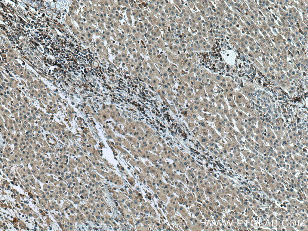 Immunohistochemistry (IHC) staining of human liver cancer tissue using GCK Polyclonal antibody (15629-1-AP)