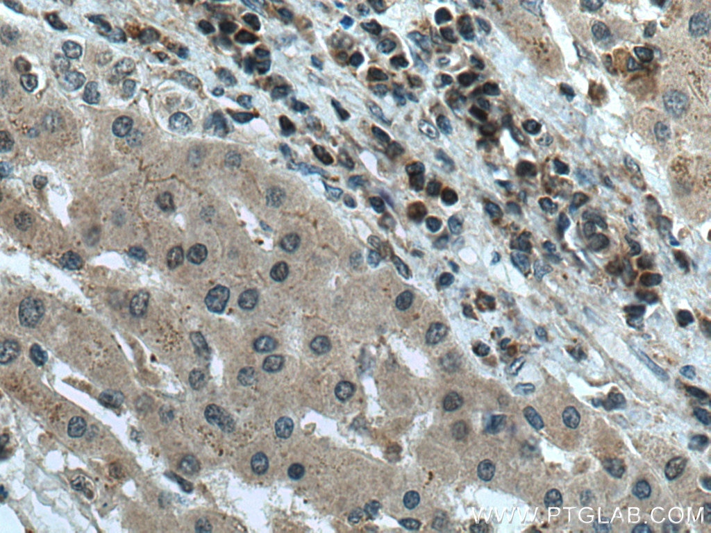 Immunohistochemistry (IHC) staining of human liver cancer tissue using GCK Polyclonal antibody (15629-1-AP)