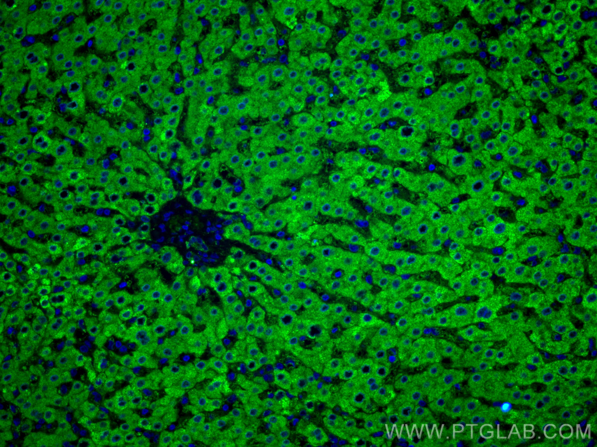 Immunofluorescence (IF) / fluorescent staining of human liver cancer tissue using GCK Monoclonal antibody (67216-1-Ig)