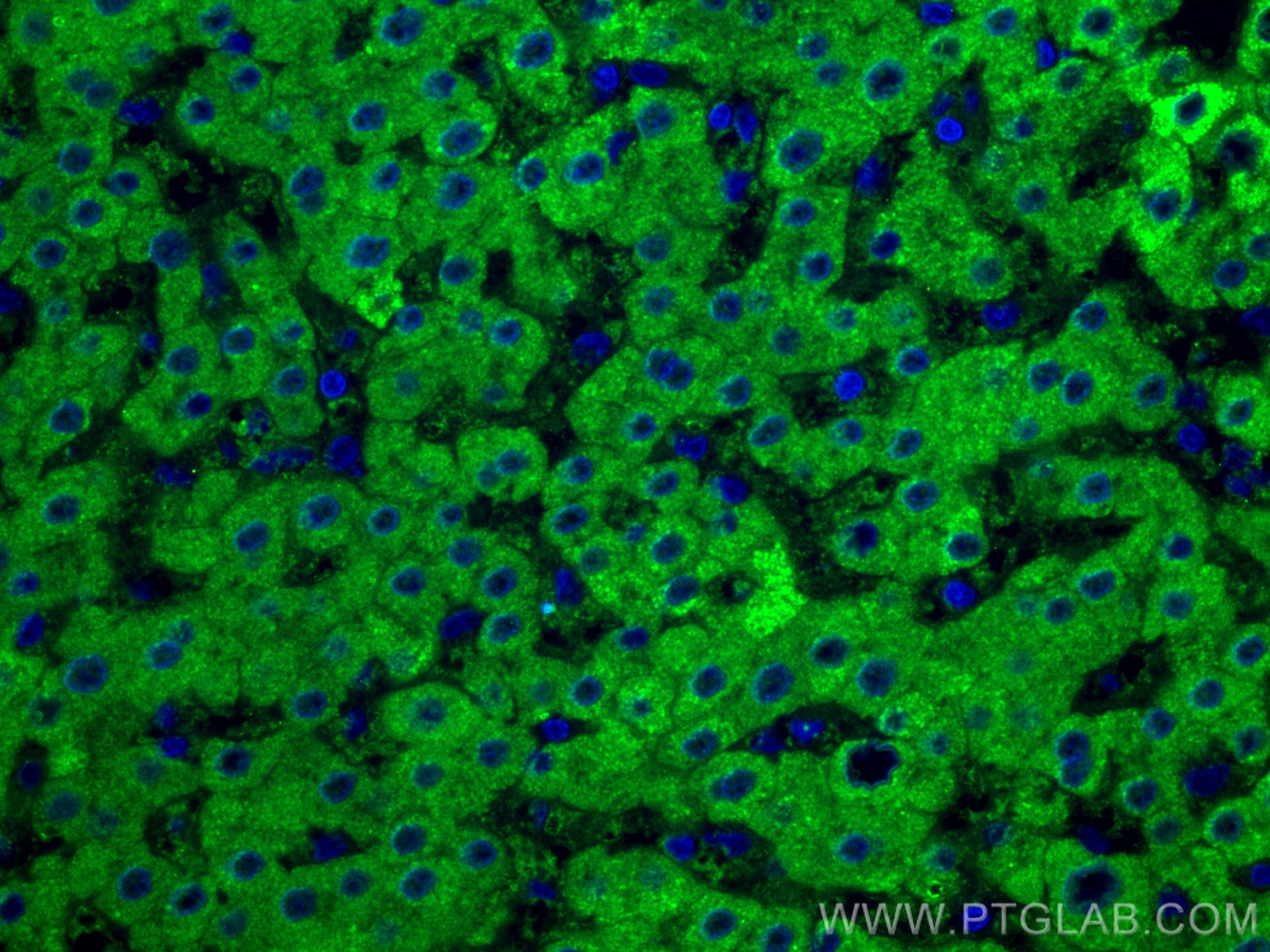 Immunofluorescence (IF) / fluorescent staining of human liver cancer tissue using GCK Monoclonal antibody (67216-1-Ig)