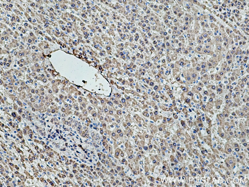 IHC staining of human liver cancer using 67216-1-Ig