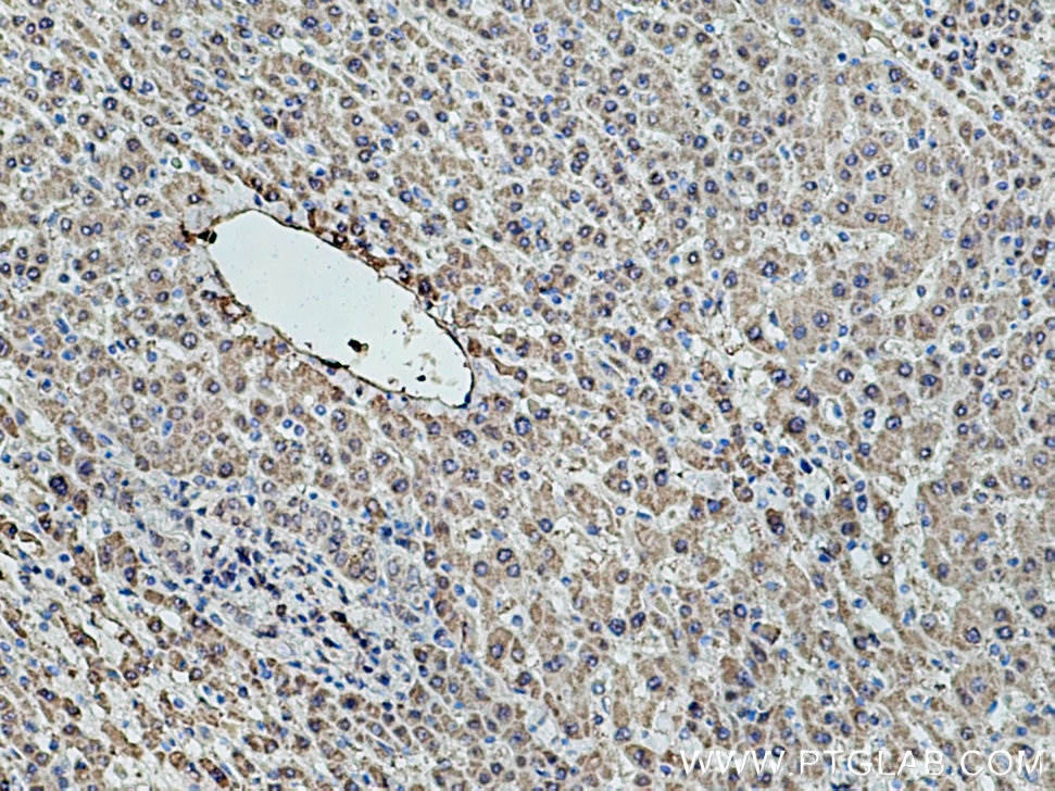 Immunohistochemistry (IHC) staining of human liver cancer tissue using GCK Monoclonal antibody (67216-1-Ig)