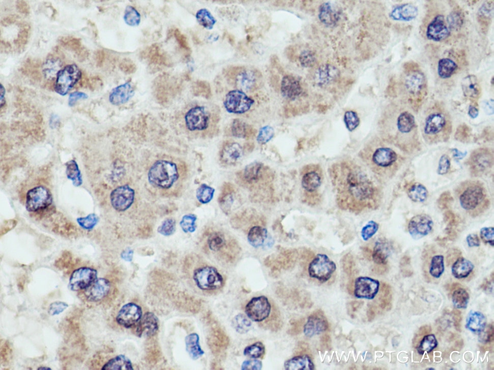 Immunohistochemistry (IHC) staining of human liver cancer tissue using GCK Monoclonal antibody (67216-1-Ig)