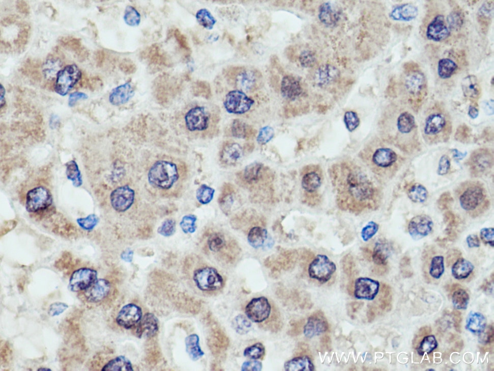 IHC staining of human liver cancer using 67216-1-Ig