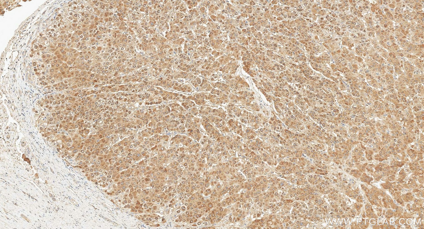 IHC staining of human liver cancer using 67216-1-Ig Immunohistochemistry (IHC) staining of human liver cancer tissue using GCK Monoclonal antibody (67216-1-Ig)