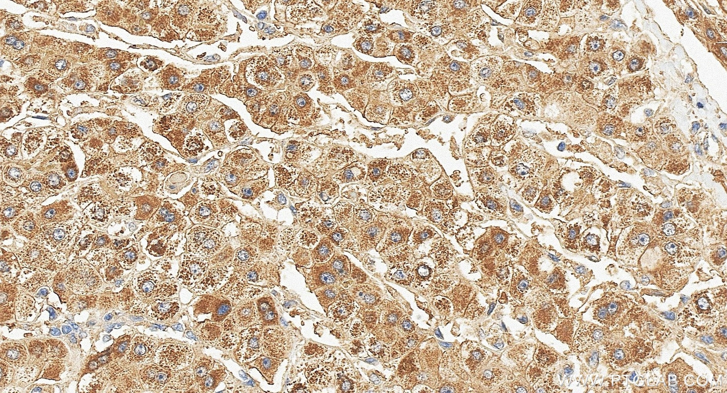 IHC staining of human liver cancer using 67216-1-Ig Immunohistochemistry (IHC) staining of human liver cancer tissue using GCK Monoclonal antibody (67216-1-Ig)