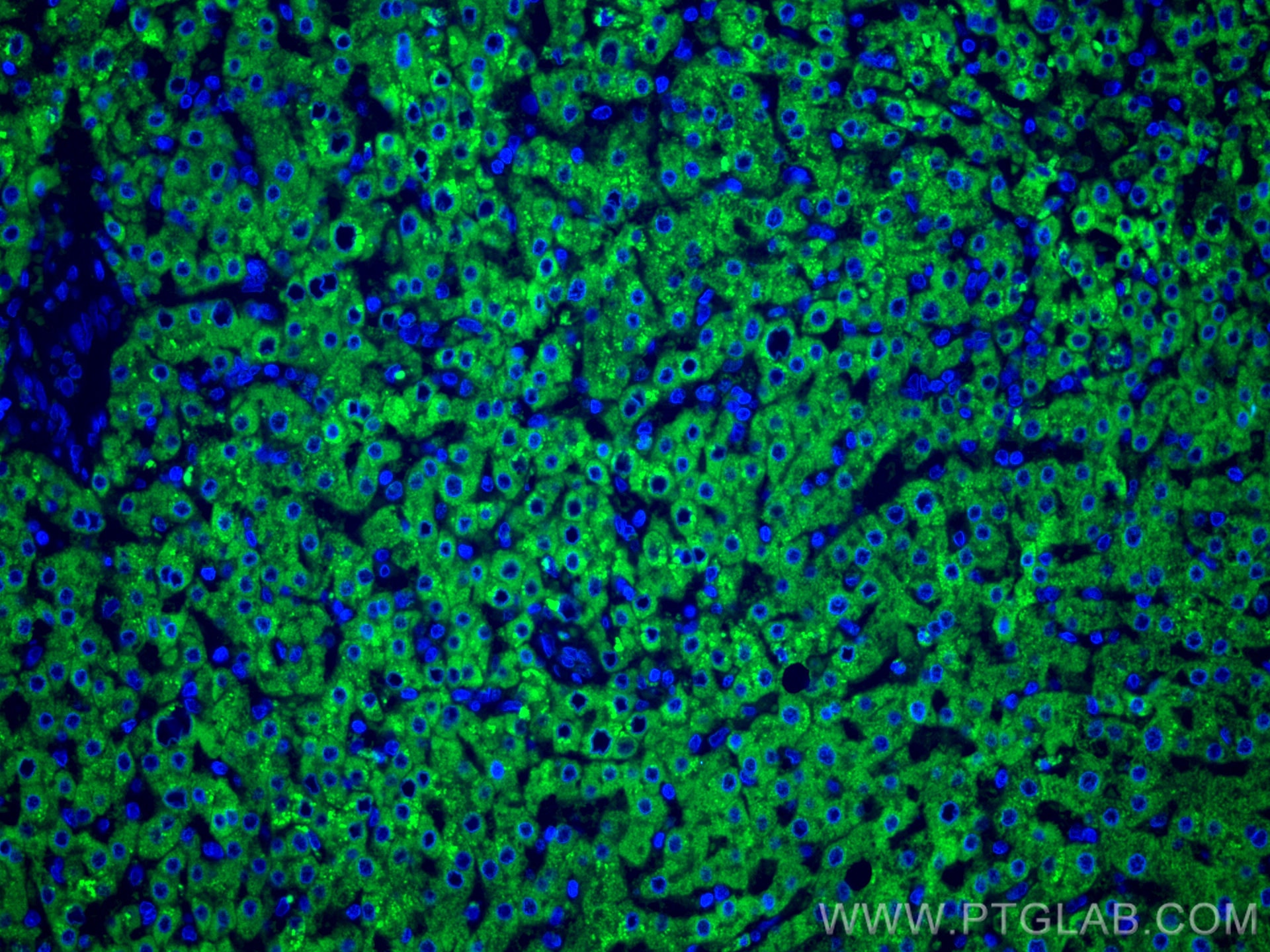 Immunofluorescence (IF) / fluorescent staining of human liver cancer tissue using CoraLite® Plus 488-conjugated GCK Monoclonal antib (CL488-67216)