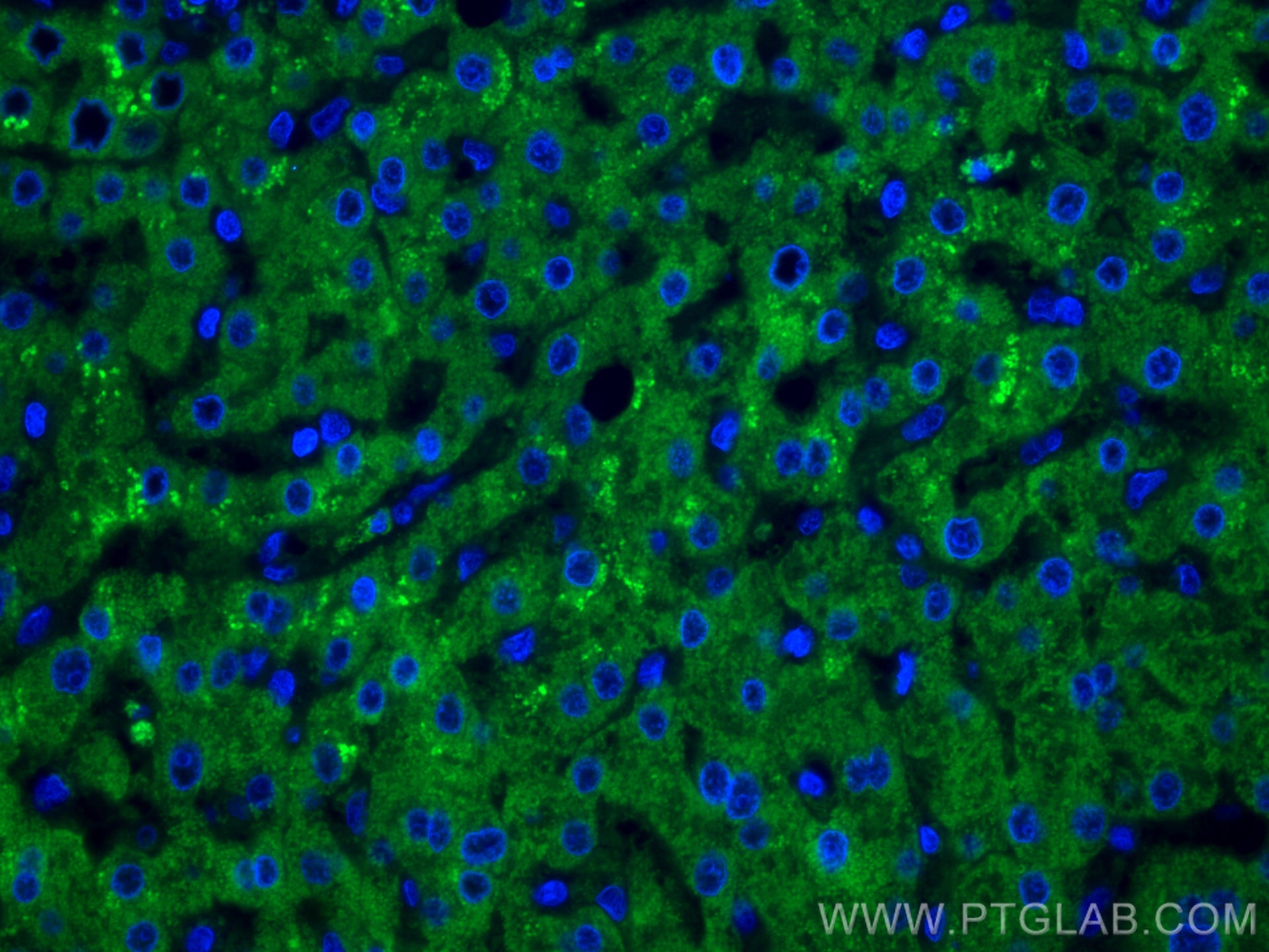 Immunofluorescence (IF) / fluorescent staining of human liver cancer tissue using CoraLite® Plus 488-conjugated GCK Monoclonal antib (CL488-67216)