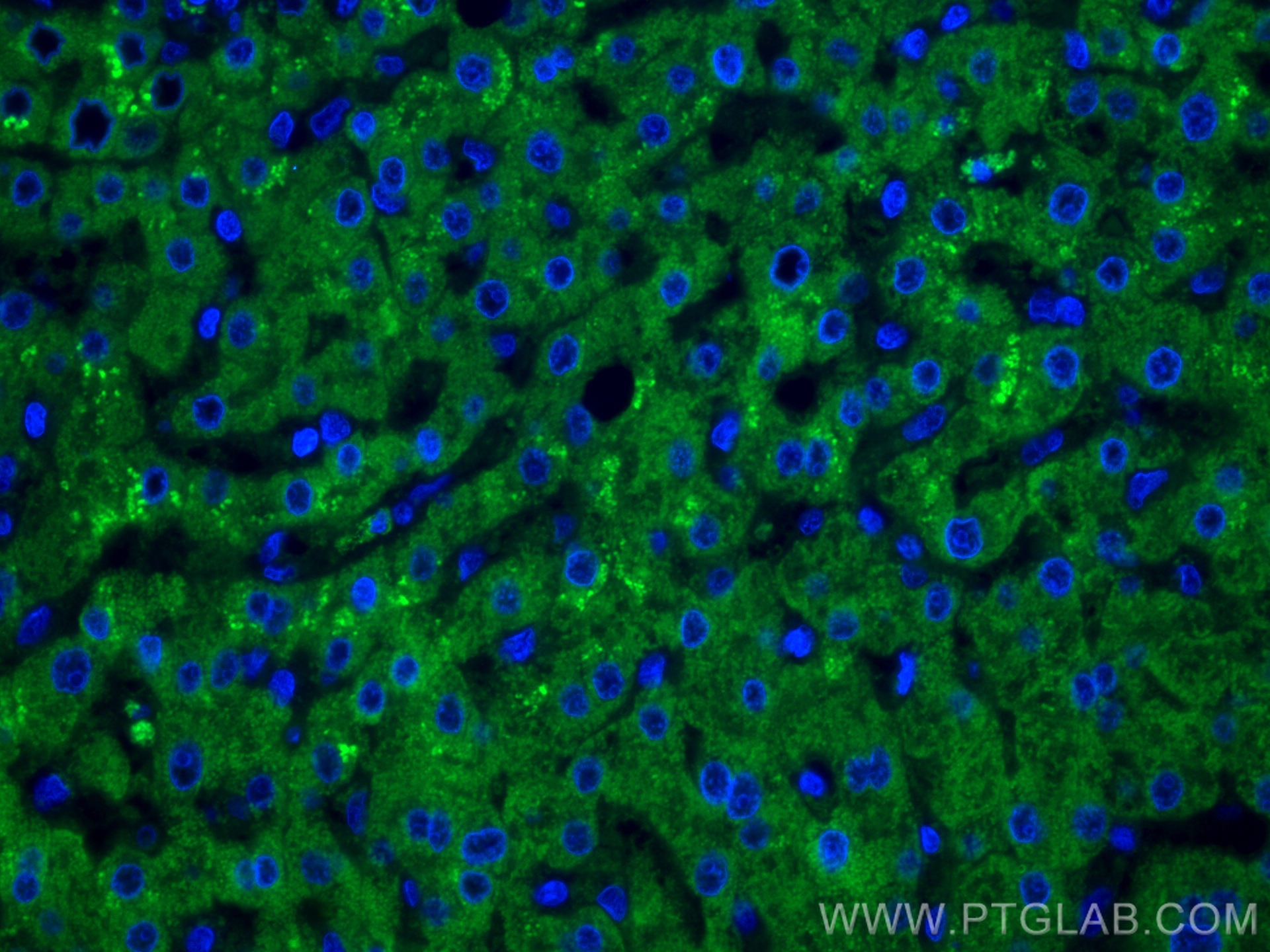 Immunofluorescence (IF) / fluorescent staining of human liver cancer tissue using CoraLite® Plus 488-conjugated GCK Monoclonal antib (CL488-67216)