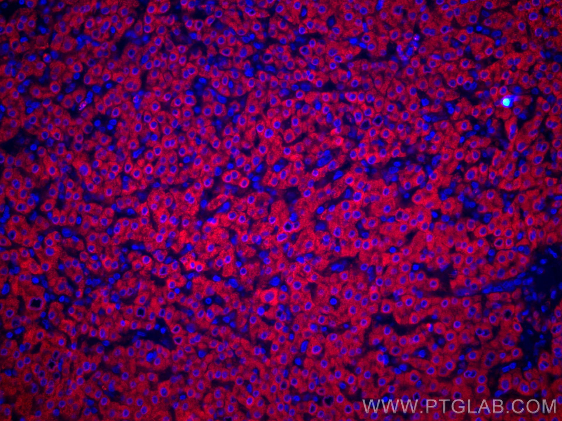 IF Staining of human liver cancer using CL594-67216