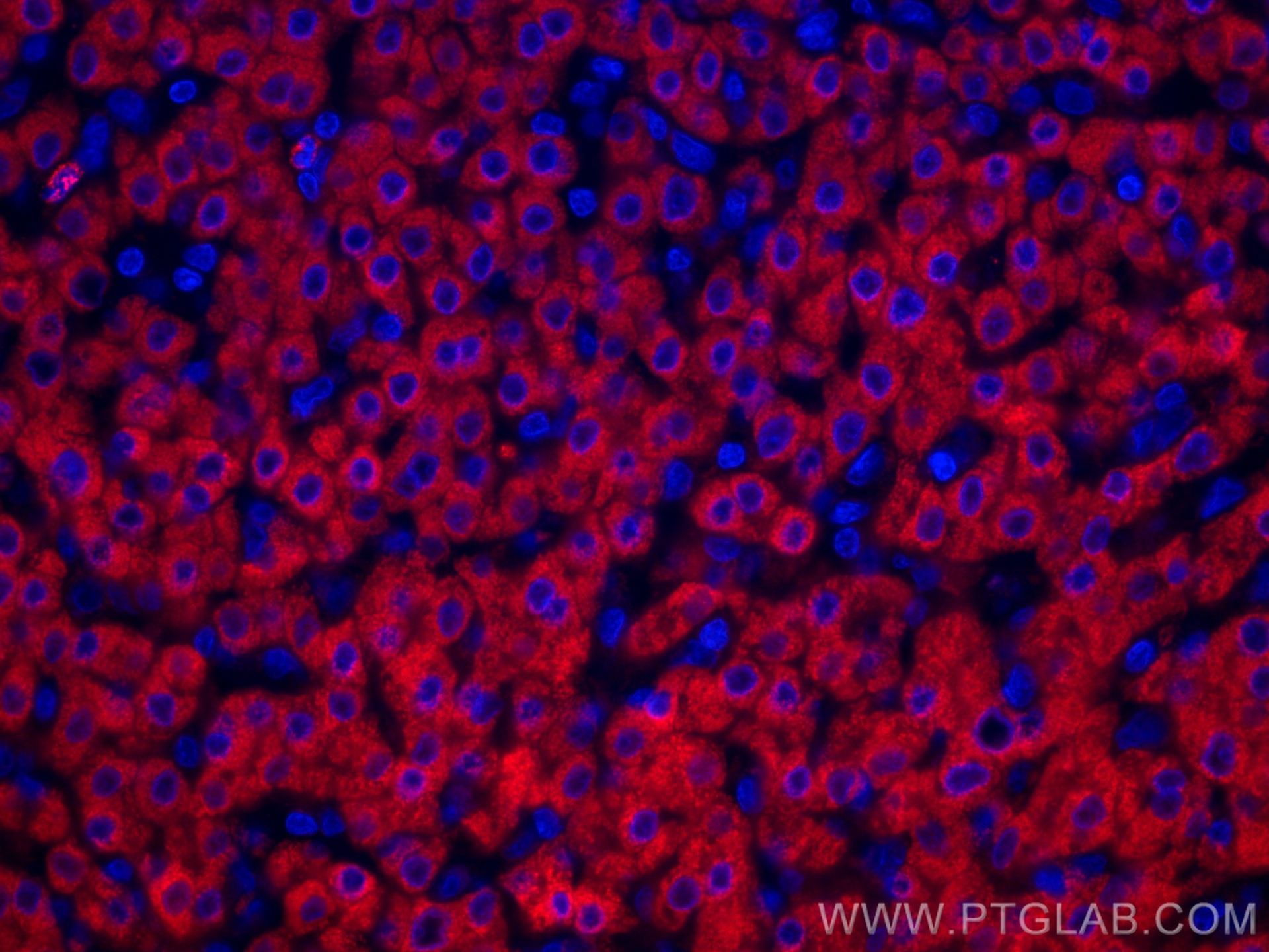 Immunofluorescence (IF) / fluorescent staining of human liver cancer tissue using CoraLite®594-conjugated GCK Monoclonal antibody (CL594-67216)
