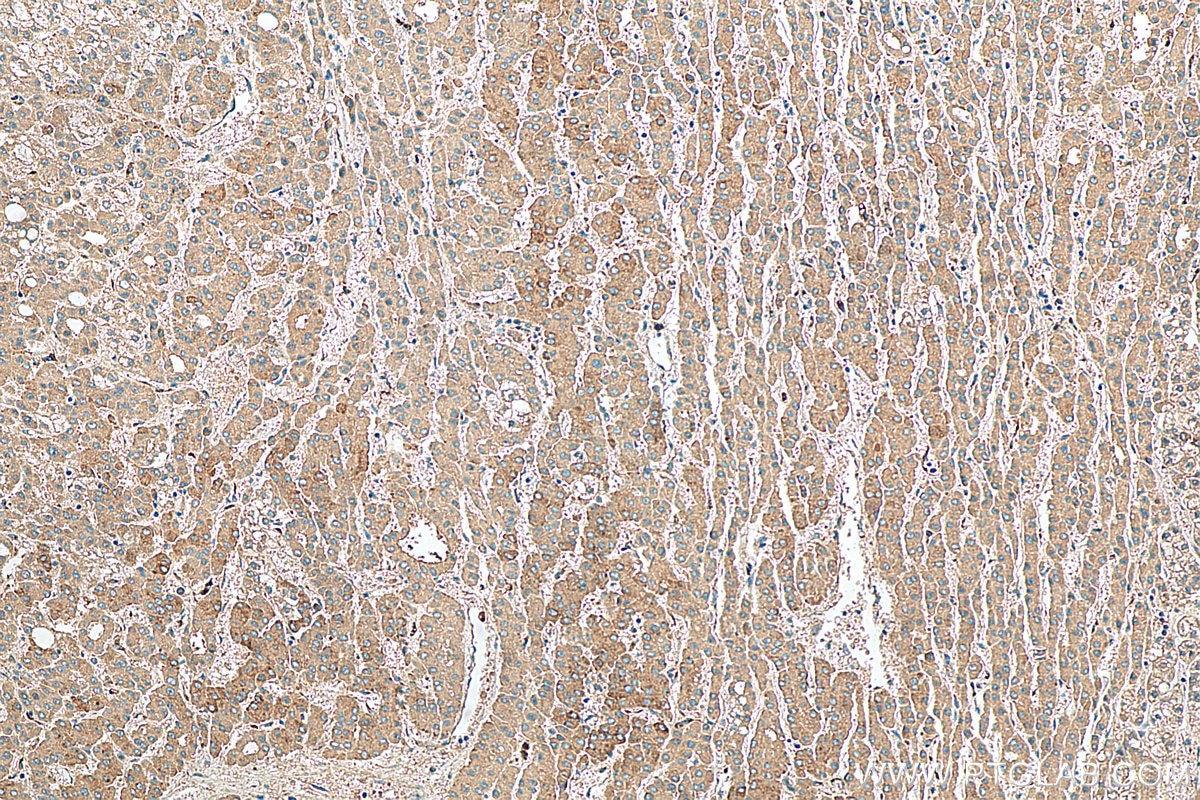 IHC staining of human liver cancer using 14241-1-AP