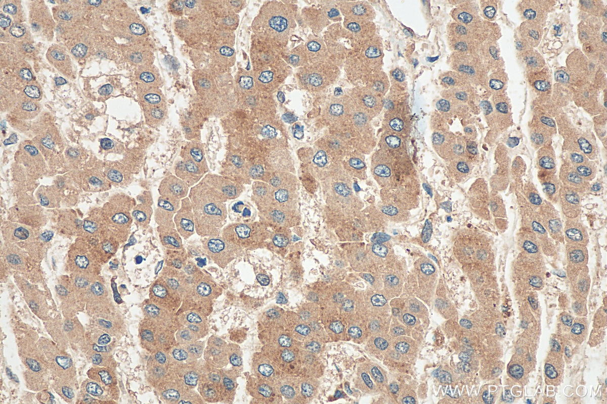 Immunohistochemistry (IHC) staining of human liver cancer tissue using GCLM Polyclonal antibody (14241-1-AP)