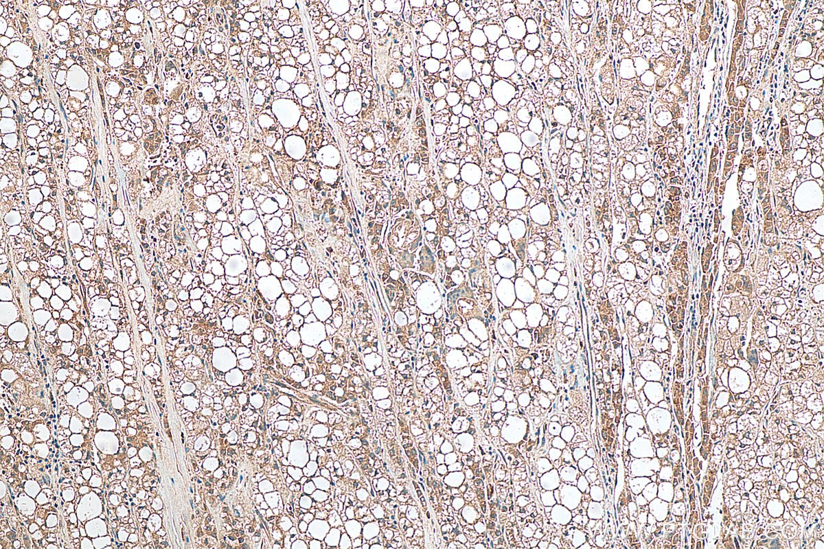 Immunohistochemistry (IHC) staining of human liver cancer tissue using GCLM Polyclonal antibody (14241-1-AP)