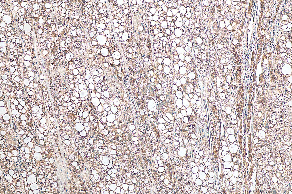 IHC staining of human liver cancer using 14241-1-AP