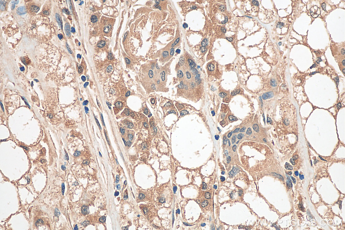 Immunohistochemistry (IHC) staining of human liver cancer tissue using GCLM Polyclonal antibody (14241-1-AP)