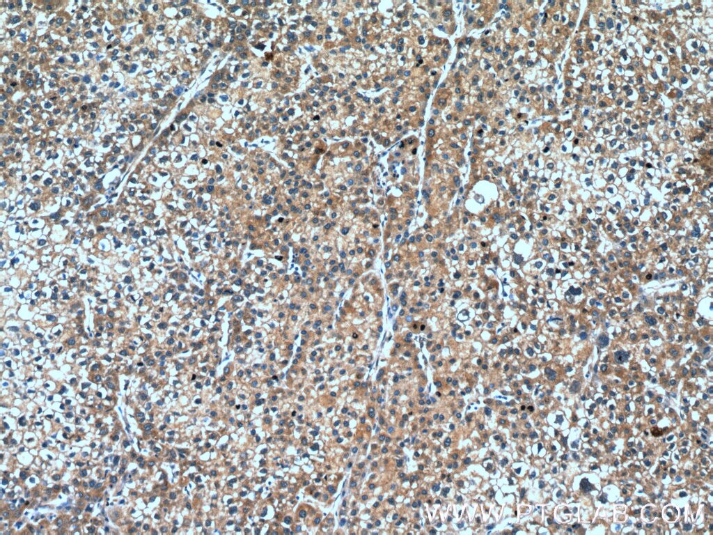 IHC staining of human liver cancer using 14241-1-AP