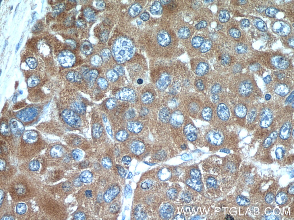 IHC staining of human liver cancer using 14241-1-AP