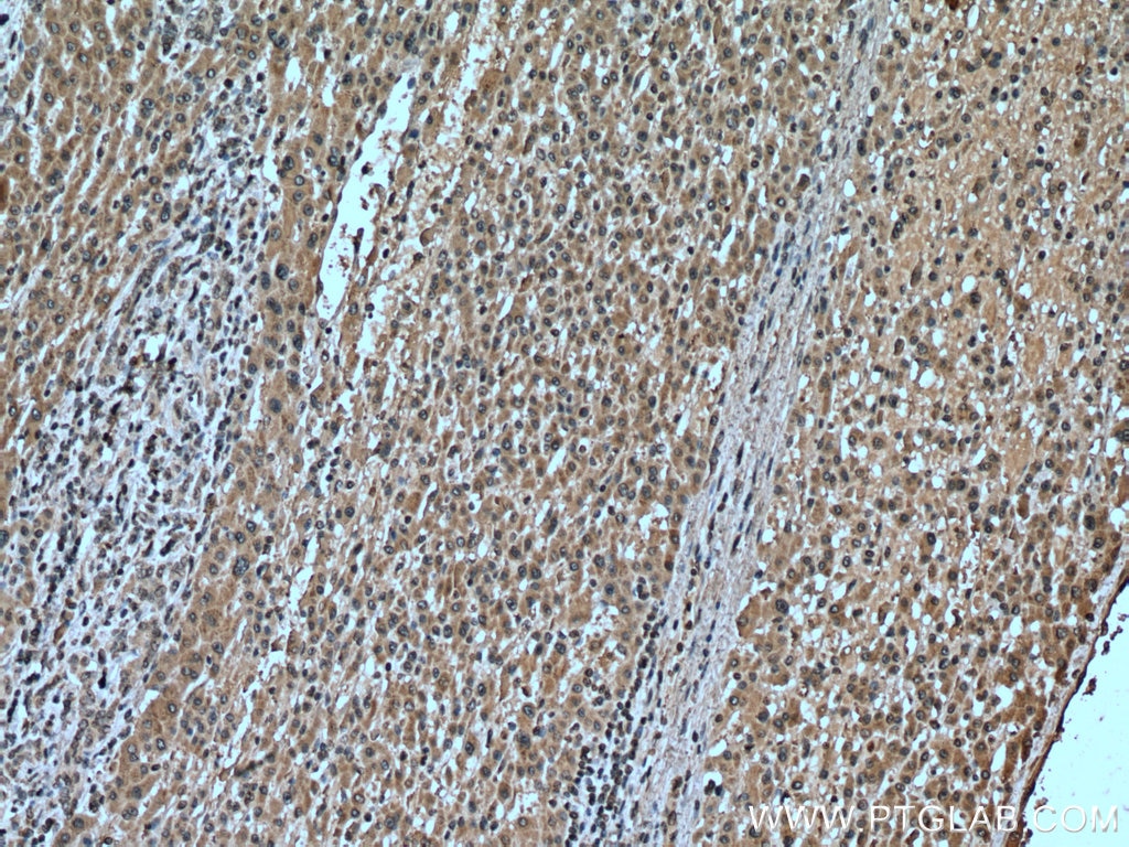 Immunohistochemistry (IHC) staining of human liver cancer tissue using GCLM Monoclonal antibody (66808-1-Ig)