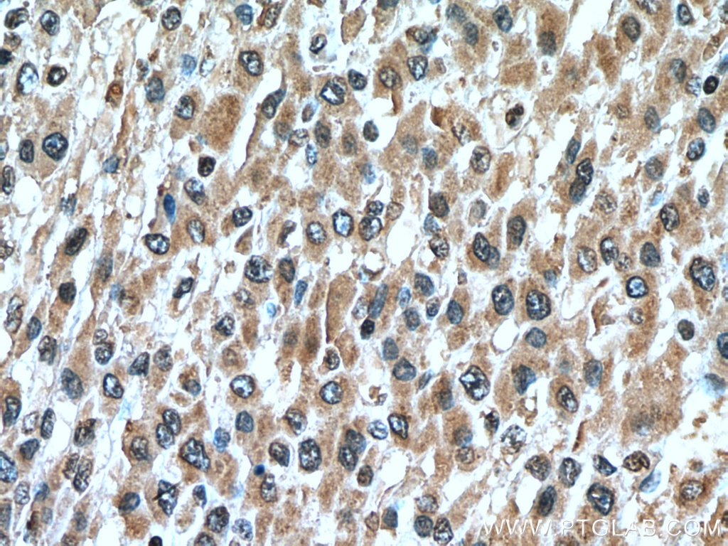 Immunohistochemistry (IHC) staining of human liver cancer tissue using GCLM Monoclonal antibody (66808-1-Ig)