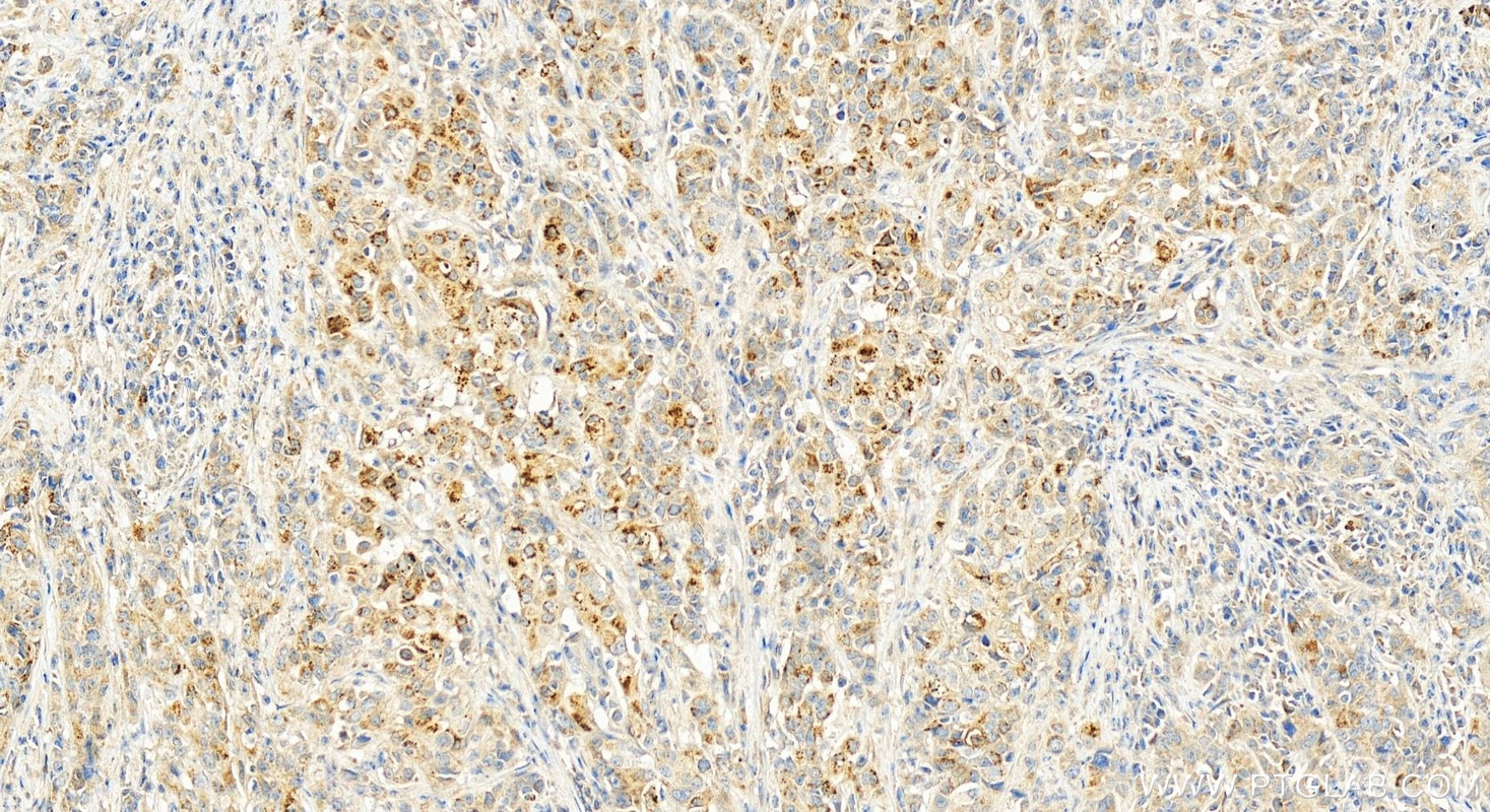 Immunohistochemistry (IHC) staining of human stomach cancer tissue using GCNT3 Polyclonal antibody (17101-1-AP)