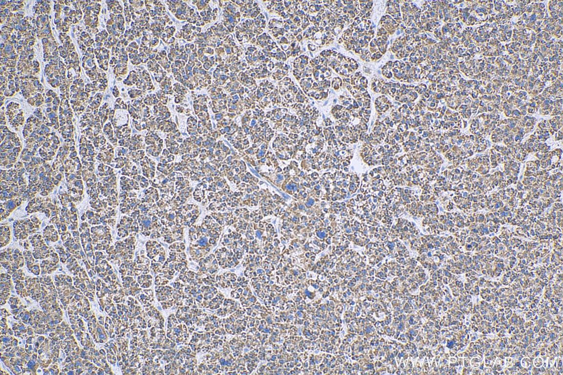 Immunohistochemistry (IHC) staining of human liver cancer tissue using GCOM1 Polyclonal antibody (18129-1-AP)