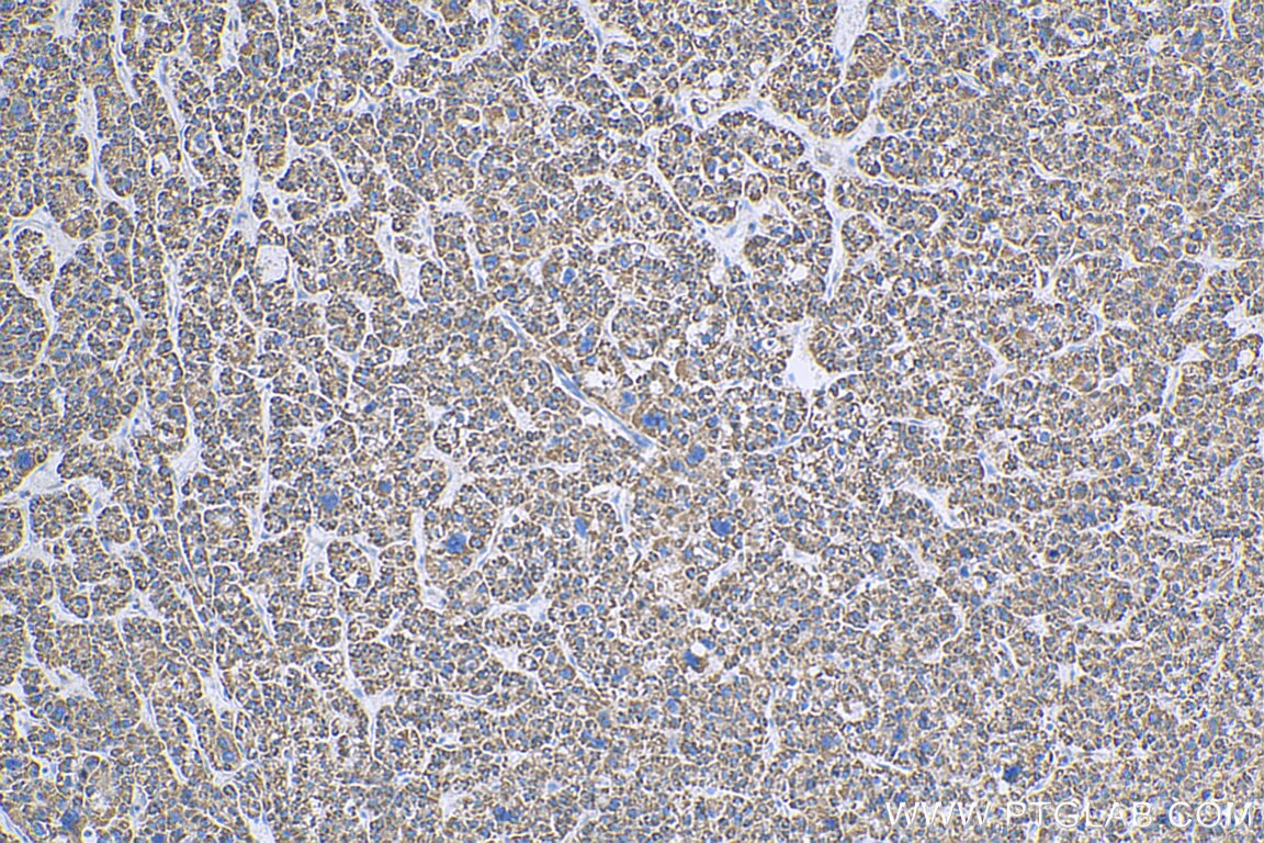 Immunohistochemistry (IHC) staining of human liver cancer tissue using GCOM1 Polyclonal antibody (18129-1-AP)