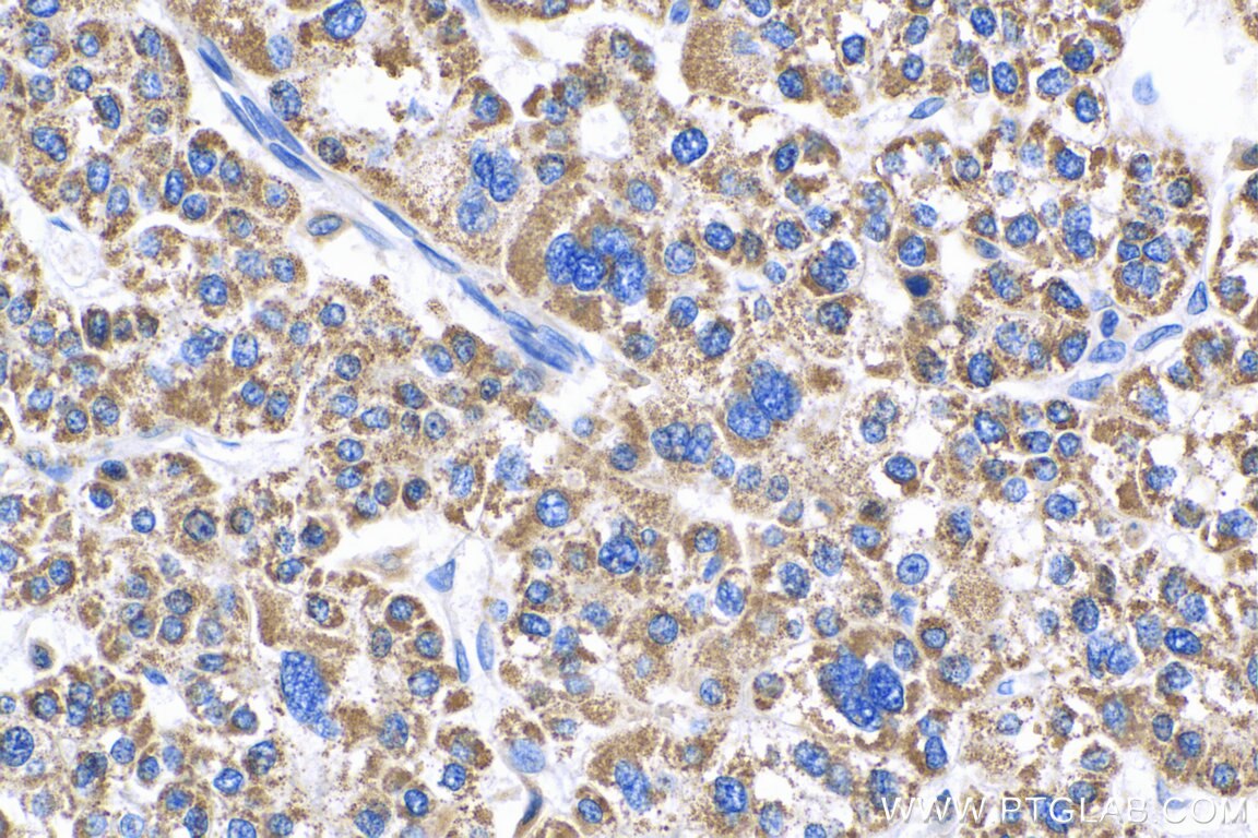 Immunohistochemistry (IHC) staining of human liver cancer tissue using GCOM1 Polyclonal antibody (18129-1-AP)