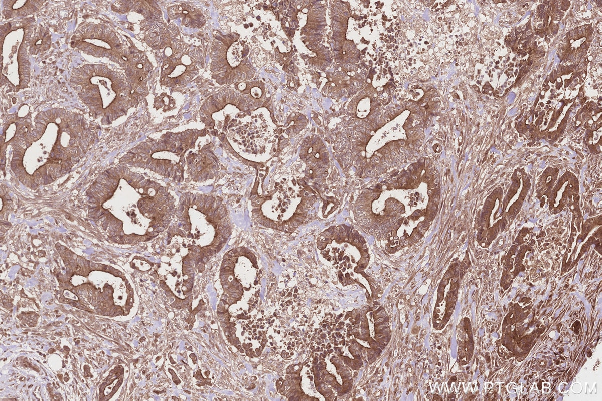 Immunohistochemistry (IHC) staining of human rectal cancer tissue using GCP6 Polyclonal antibody (25022-1-AP)