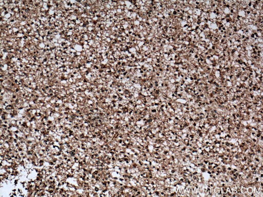 Immunohistochemistry (IHC) staining of human gliomas tissue using GDAP1L1 Polyclonal antibody (11977-1-AP)