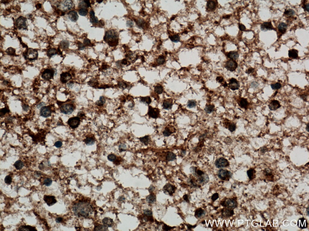 Immunohistochemistry (IHC) staining of human gliomas tissue using GDAP1L1 Polyclonal antibody (11977-1-AP)