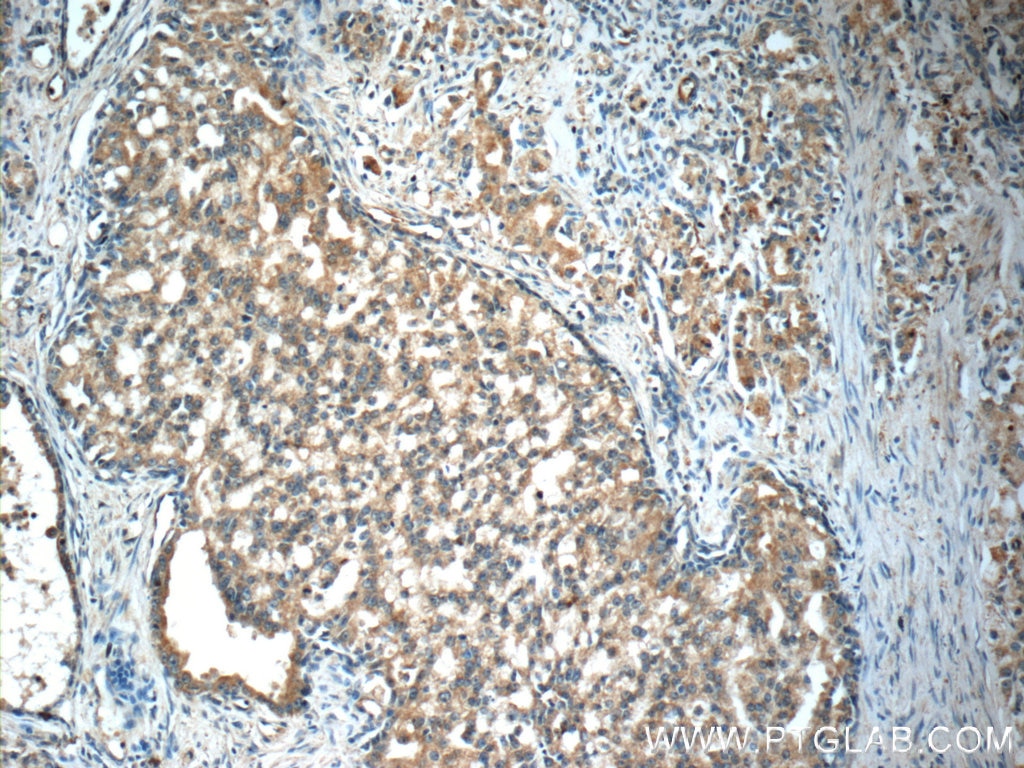 Immunohistochemistry (IHC) staining of human prostate cancer tissue using GDEP Polyclonal antibody (22744-1-AP)