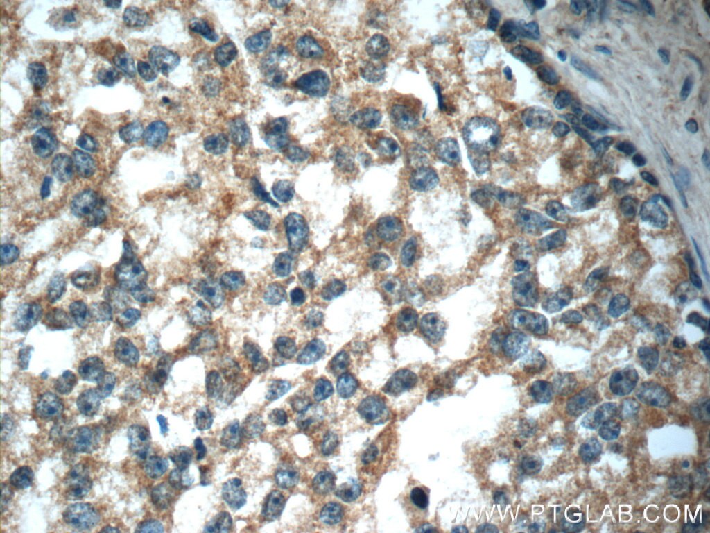 Immunohistochemistry (IHC) staining of human prostate cancer tissue using GDEP Polyclonal antibody (22744-1-AP)