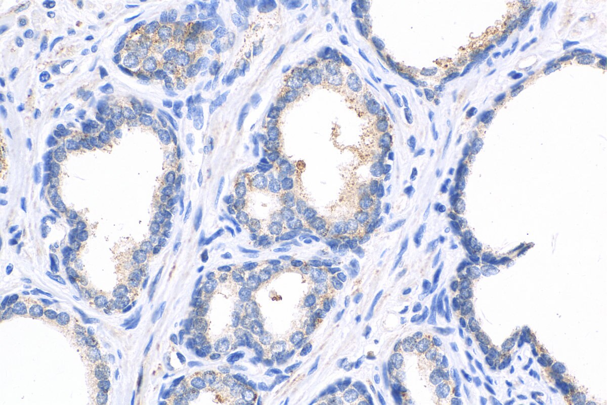 Immunohistochemistry (IHC) staining of human prostate cancer tissue using GDEP Polyclonal antibody (22744-1-AP)