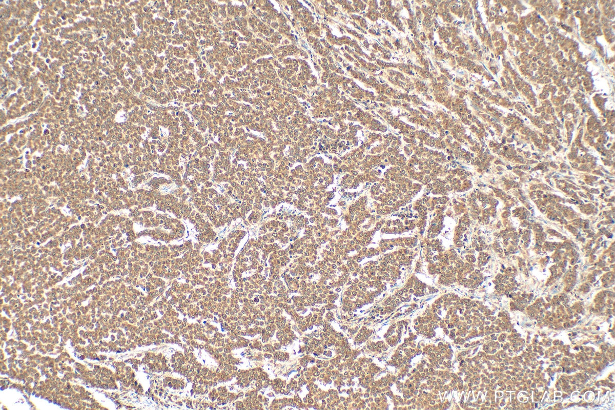 Immunohistochemistry (IHC) staining of human colon cancer tissue using GDF11 Polyclonal antibody (26715-1-AP)