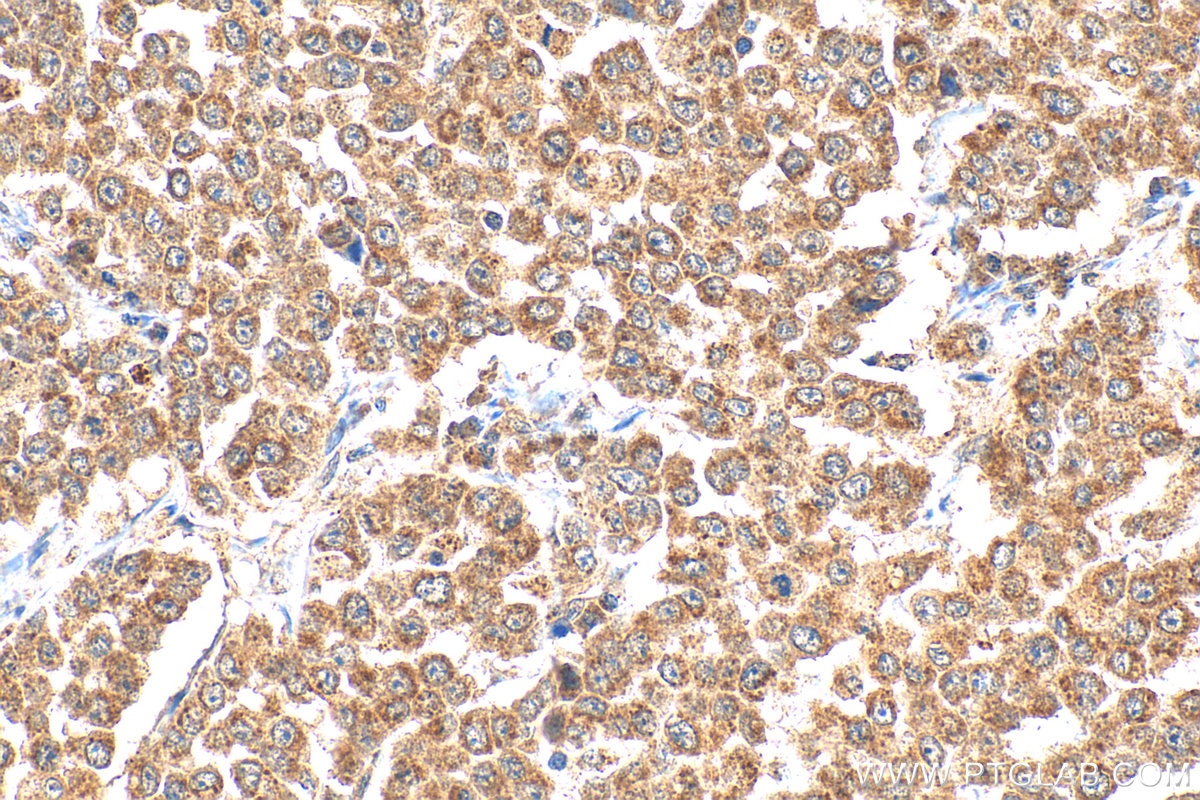 Immunohistochemistry (IHC) staining of human colon cancer tissue using GDF11 Polyclonal antibody (26715-1-AP)