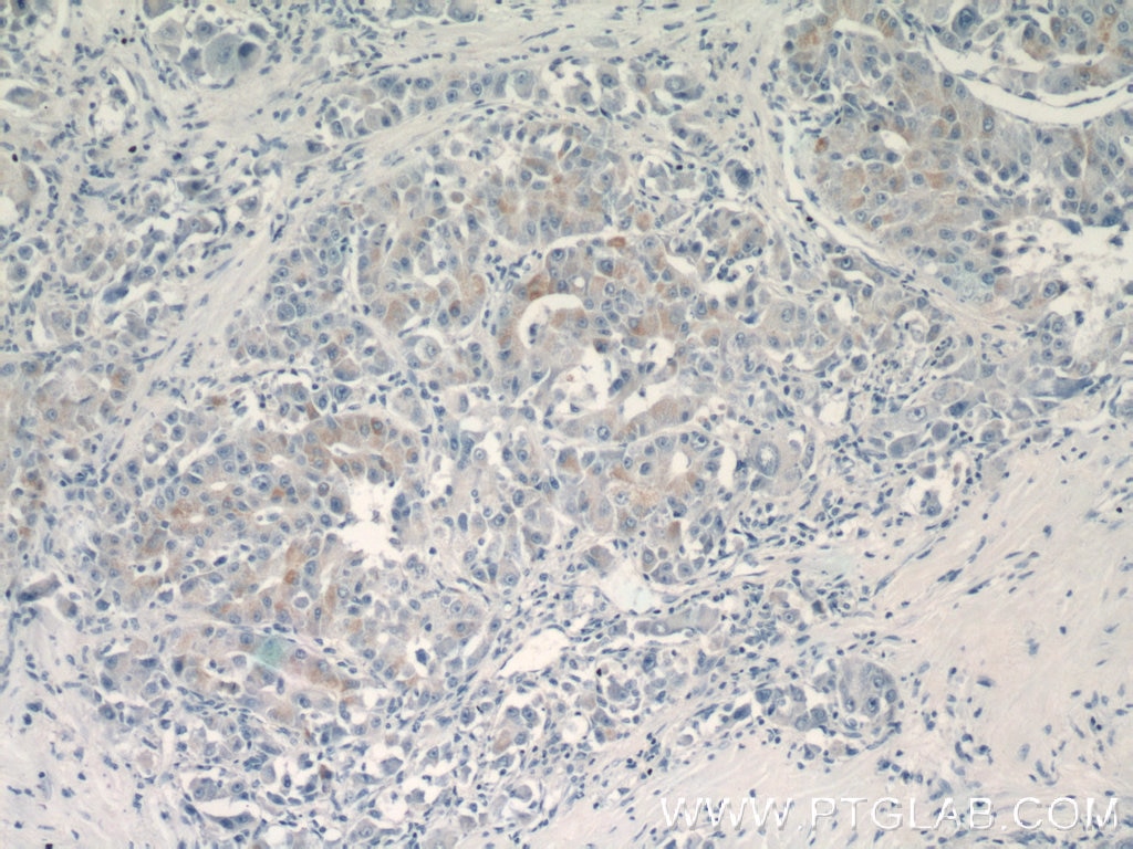Immunohistochemistry (IHC) staining of human liver cancer tissue using BMP9 Polyclonal antibody (17769-1-AP)
