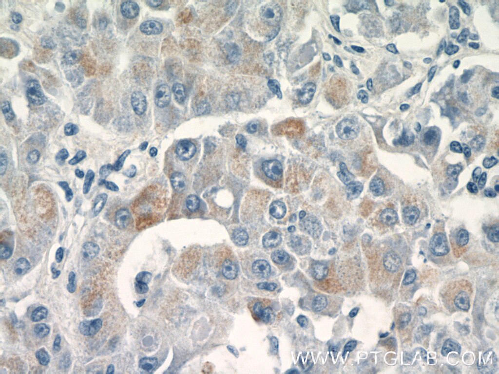 Immunohistochemistry (IHC) staining of human liver cancer tissue using BMP9 Polyclonal antibody (17769-1-AP)