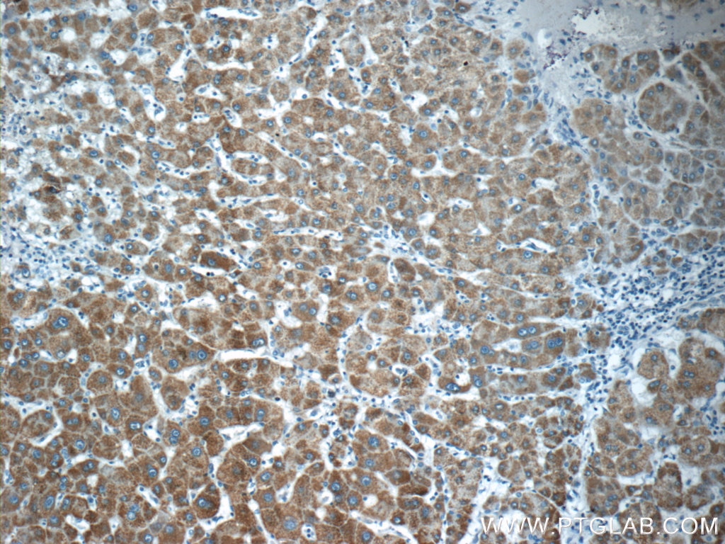 Immunohistochemistry (IHC) staining of human hepatocirrhosis tissue using BMP9 Polyclonal antibody (17769-1-AP)