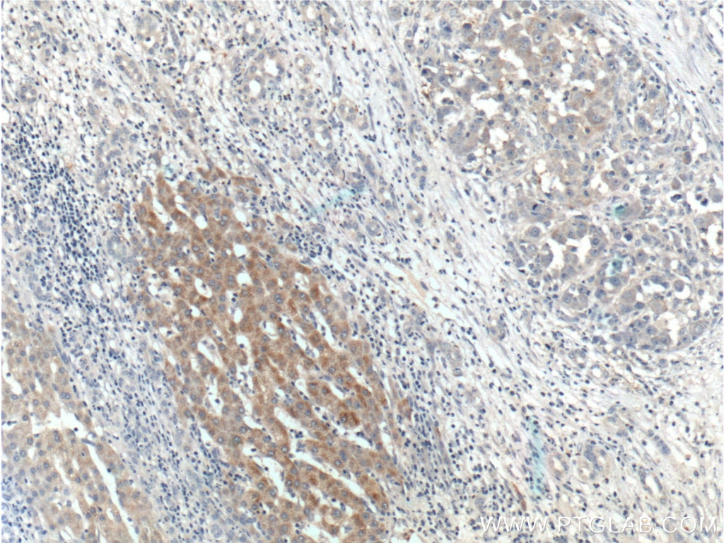 IHC staining of human liver cancer using 17769-1-AP