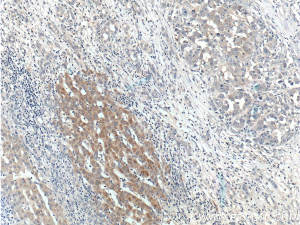 Immunohistochemistry (IHC) staining of human liver cancer tissue using BMP9 Polyclonal antibody (17769-1-AP)