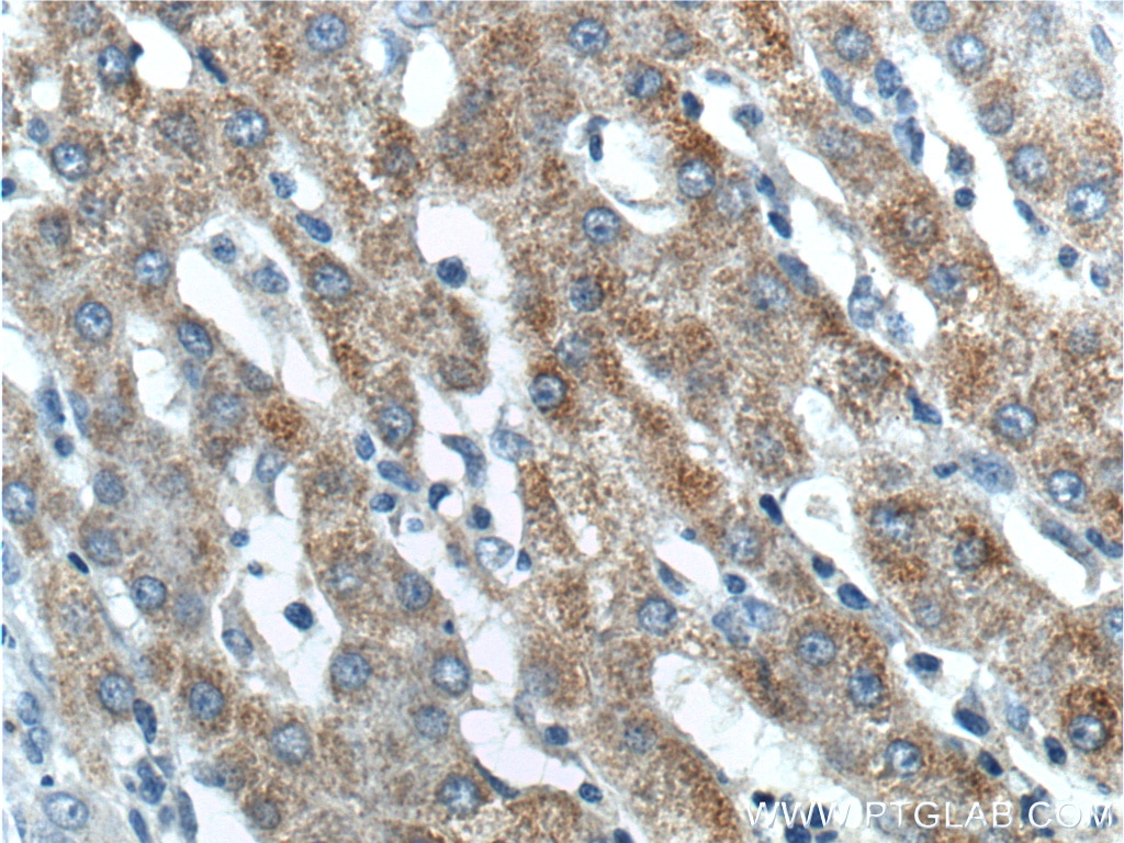 Immunohistochemistry (IHC) staining of human liver cancer tissue using BMP9 Polyclonal antibody (17769-1-AP)