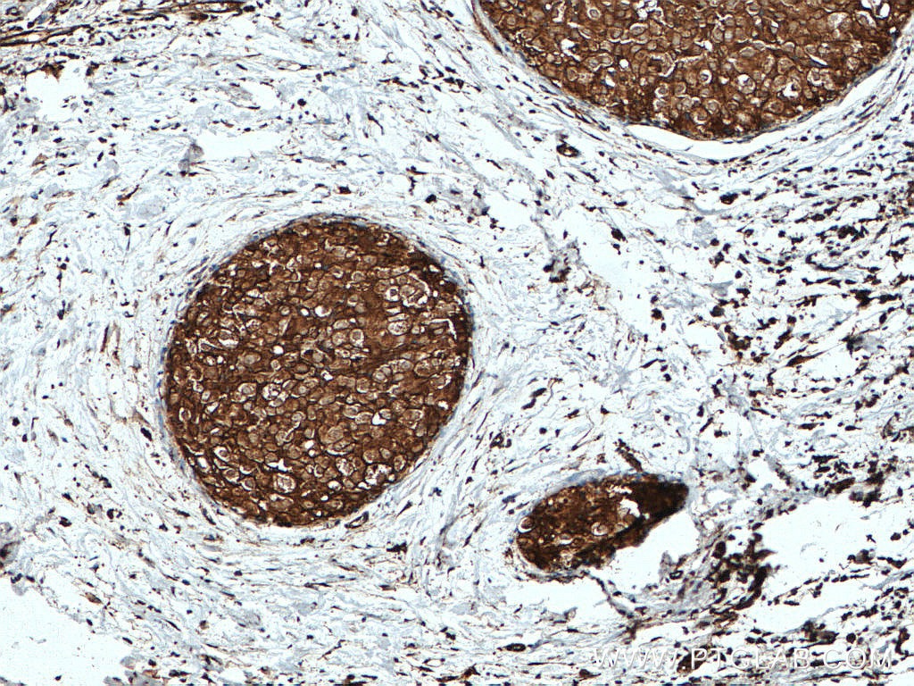 Immunohistochemistry (IHC) staining of human breast cancer tissue using GDI1 Polyclonal antibody (10249-1-AP)