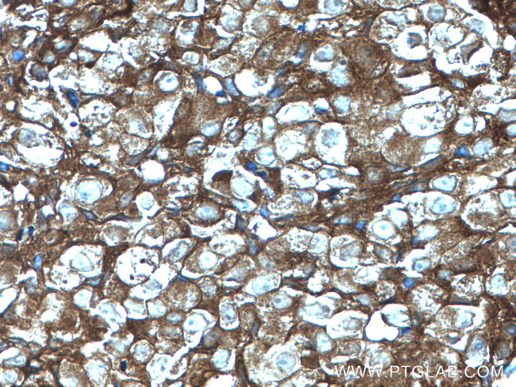 Immunohistochemistry (IHC) staining of human breast cancer tissue using GDI1 Polyclonal antibody (10249-1-AP)